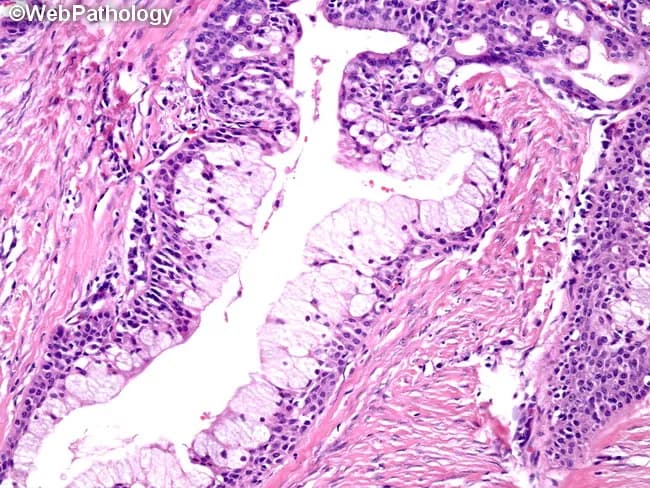 This Light Microscopy image depicts a low-grade mucoepidermoid carcinoma of a salivary gland (likely parotid region) on a hematoxylin and eosin stained section. The tumor demonstrates a mixed cellular phenotype consisting of mucin-producing goblet/balloon cells with abundant foamy cytoplasm, along with epidermoid (squamous) cells and intermediate cells. The mucous cells form cystic or gland-like spaces that may be simple-lined or display complex cribriform and papillary architectures. In places, mucous and epidermoid components occur in solid nests, reflecting the biphasic differentiation typical of MEC. The cyst lining ranges from a single cell layer to multilayered epithelium within fibrous stroma. Overall pattern is predominantly cystic with scattered solid areas, consistent with a low-grade neoplasm; mitotic activity is low and cytologic atypia is minimal. The photograph emphasizes the diagnostic hallmarks: mucous cell predominance, duct-like glandular spaces, cohesive nests of epidermoid cells, and cribriform/papillary configurations. Clinically, MEC is the most common malignant salivary gland tumor; grading (low, intermediate, high) guides prognosis and treatment including surgical excision and possible radiotherapy. The image is valuable for education and pathology training, enabling recognition of cell-lineage diversity, mucin production, and architectural patterns that distinguish MEC from adenosquamous and other salivary gland carcinomas.