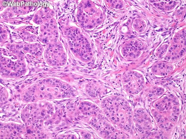 Imaging modality: light microscopy of an H&E–stained histology section from a recurrent submandibular gland mass. Primary subject: high‑grade mucoepidermoid carcinoma with scant cyst formation. Precise anatomical location: submandibular region (salivary gland), head and neck. Visual features: predominantly solid sheets and clusters of epidermoid (squamoid) and intermediate cells displaying cytologic atypia, marked nuclear pleomorphism, prominent nucleoli, and brisk mitotic activity. Keratinization is limited; extensive keratin pearls are not present; occasional small keratin pearls or individual cell keratinization may be seen. Mucicarmine-positive mucous cells are scattered throughout the tumor, indicating mixed differentiation with mucous-secreting components. The stroma is variable with embedded tumor nests and occasional duct-like structures; no prominent cystic spaces are described. Imaging perspective: micrographic cross-sections at high magnification highlight cellular morphology and intercellular bridges. Diagnostic interpretation: high-grade MEC with aggressive features, potential to mimic moderately differentiated squamous cell carcinoma but mucous cell component and mucicarmine positivity support MEC; absence of large keratin pearls argues against classic keratinizing SCC. Clinical relevance: biopsy morphology is essential for grading, prognosis, and therapeutic planning, as high‑grade MEC carries higher risk of recurrence and regional/metastatic spread; findings justify surgical management with consideration of adjuvant therapy and close follow-up.