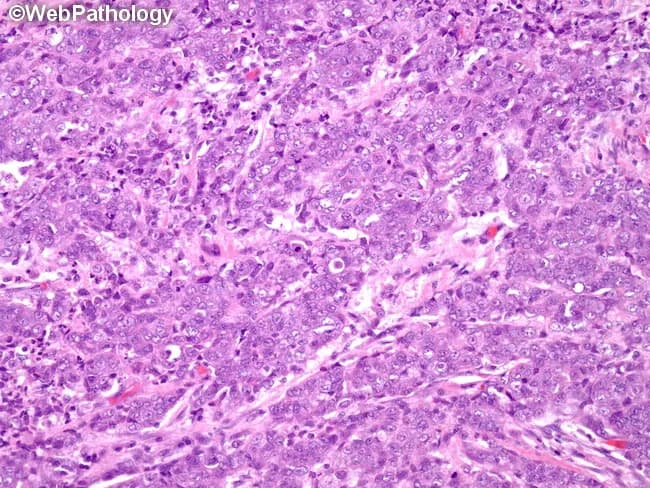 This histopathology image shows mucoepidermoid carcinoma of a salivary gland captured on a hematoxylin and eosin stained slide. The tissue reveals a biphasic neoplasm composed of mucous-secreting cells intermingled with epidermoid (squamoid) cells and intermediate cell types, arranged in cystic and solid nests within a fibrous stroma. Mucous cells contain intracellular mucin, while squamous-like cells exhibit intercellular bridges and nuclear pleomorphism to a variable degree. Duct-like structures and hyalinized bands may be present, reflecting ductal differentiation and cribriform-pattern areas characteristic of MEC. The overall architectural pattern is infiltrative, with variable cellularity and a range of cytologic atypia from low to moderate, consistent with intermediate or higher-grade features depending on additional criteria. Mitotic figures may be seen but are not prominently counted in this field; necrosis is not conspicuously evident here. Clinical significance of these histologic features lies in AFIP three-tier grading, where intracystic component, perineural invasion, necrosis, mitoses, and anaplasia determine low-, intermediate-, or high-grade status, guiding prognosis and treatment. This image is valuable for educational purposes, differential diagnosis discussions with adenoid cystic or other salivary gland carcinomas, and pathology training in head and neck oncology. It also supports correlation with imaging, surgical planning, and targeted therapeutic decisions for patients.