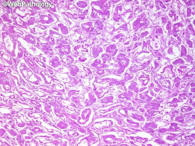 This is a histopathology image of a salivary gland neoplasm showing acinic cell carcinoma with a follicular/glandular pattern. The material is a Hematoxylin and Eosin stained section viewed on light microscopy. Tumor architecture displays microcystic and follicular arrangements with round to oval acinar cells that have granular basophilic cytoplasm and small, central nuclei. Cytoplasmic granules represent zymogen granules consistent with serous acinar differentiation. The lesion shows ducts and cyst-like lumina within nests of tumor cells, with relatively mild cytologic atypia and infrequent mitotic activity. In places, cells form sheets and tubules that emphasize the glandular component. Overall, the image illustrates the characteristic acinic cell histology and the follicular variant pattern described in the literature. Diagnostic significance lies in recognizing serous acinar differentiation to distinguish acinic cell carcinoma from mucoepidermoid carcinoma or adenoid cystic carcinoma, which have different management and prognosis. Clinically, patients typically present with a slowly enlarging parotid or minor salivary gland mass. Immunohistochemical panels and molecular studies can aid confirmation. For education and research, this image serves as a reference for pattern recognition, differential diagnosis, and teaching about salivary gland neoplasms and their histologic subtypes. This reference aids learners in recognizing variants and informs clinical decision making process.