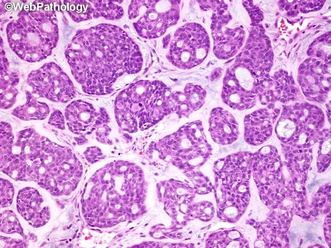 High-magnification bright-field histopathology image of salivary gland tissue demonstrating adenoid cystic carcinoma with cribriform architecture. The section is stained with Hematoxylin and Eosin and viewed under light microscopy at high magnification, revealing small, uniform basaloid tumor cells arranged in interconnected lobules and islands. The characteristic cribriform pattern forms sieve-like spaces that resemble pseudocysts rather than true glandular lumina; these spaces are surrounded by dense basaloid epithelium. The spaces are variably filled with eosinophilic material that is PAS-positive and diastase-resistant, consistent with reduplicated basal lamina, or with basophilic myxoid mucinous material that stains with Alcian blue. The tumor cells exhibit scant cytoplasm, hyperchromatic nuclei, and a biphasic matrix comprising hyaline-like stroma within lobules. Perineural invasion may be evident in some cases, contributing to local aggressiveness and recurrence. Clinically, this histology is diagnostic of adenoid cystic carcinoma, a malignant salivary gland neoplasm that shows at least cribriform, tubular, and solid growth patterns; prognosis depends on pattern, margin status, and neural invasion. This image is representative for educational purposes, pathology teaching, differential diagnosis with basal cell adenoma, and research into salivary gland malignancies. The image also serves as a reference for teaching tumor biology, differential diagnosis, and the recognition of diagnostic hallmarks essential for pathologists.