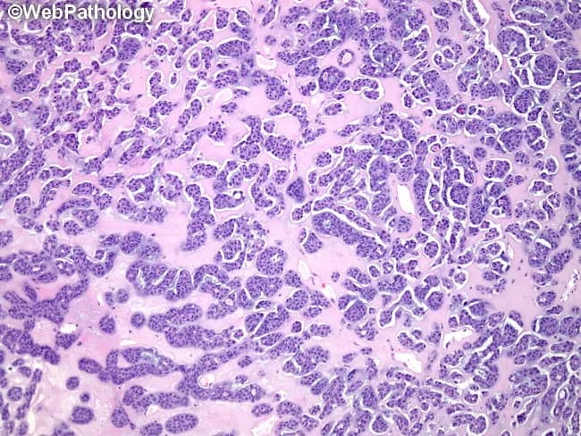 This histopathology image depicts a salivary gland neoplasm with adenoid cystic carcinoma morphology. Using light microscopy, hematoxylin and eosin staining reveals cribriform (Swiss cheese) architecture composed of small basaloid cells arranged in nests, cords, and ducts separated by thin, delicate scaffolding of mucopolysaccharide stroma. The pseudocystic spaces are conspicuously prominent and are filled by eosinophilic, hyaline material that represents duplicated basal lamina/basement membrane. The basaloid cells show scant cytoplasm, hyperchromatic elongated nuclei, and a high nuclear-to-cytoplasmic ratio; mitotic activity is typically low. The stroma surrounding the nests often appears hyalinized and may contain sialomucinous or chondroid-like elements. In typical patterns, perineural invasion may be present, reflecting aggressive clinical behavior. The appearance can alternate with tubular or solid patterns; however, the cribriform pattern with pseudocysts is characteristic. Clinically, these features support a diagnosis of adenoid cystic carcinoma of the salivary gland with a propensity for local invasion and nerve sheath infiltration. This image is relevant for educational scenarios including differential diagnosis of basaloid salivary gland tumors, radiologic-pathologic correlation, and surgical oncology planning. Keywords: adenoid cystic carcinoma, cribriform, basaloid cells, pseudocysts, basement membrane, Swiss cheese, salivary gland tumor, perineural invasion, H&E imaging.