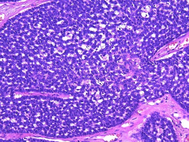 High-magnification light microscopy of a salivary gland tumor demonstrates adenoid cystic carcinoma with mixed architectural patterns. The cribriform and tubular patterns are intermixed with solid proliferations composed of basaloid cells arranged in sheets, islands, or large solid nests. The stroma is variably myxoid to hyaline (myxohyaline), providing a distinctive extracellular matrix that supports gland-like spaces and pseudocystic spaces. In solid areas, true glandular lumens are rare; tumor cells remain tightly packed with scant intervening stroma. Cellular morphology includes small, basaloid, hyperchromatic nuclei with minimal cytoplasm and conspicuous mitotic activity in some fields; nuclear pleomorphism may be present, and necrotic foci can occur in higher-grade areas. The solid pattern broader involvement correlates with higher tumor grade; grades correlate with the percentage of solid components: Grade 1 with no solid areas, Grade 2 with less than 30% solid, and Grade 3 with more than 30% solid pattern. Clinically, a larger solid component is associated with increased risk of recurrence, metastasis, and poorer outcome. This image captures the diagnostic features that support histopathologic grading, prognostication, and therapeutic planning, including surgical excision and consideration of adjuvant radiotherapy. Recognize basaloid morphology, cribriform glandular architecture, and myxohyaline stroma as hallmarks of ACC. Useful for teaching cases.