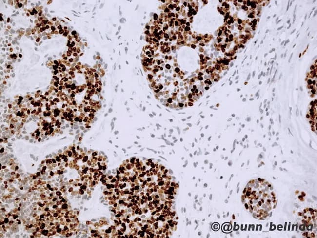 Brightfield immunohistochemistry image of a formalin-fixed paraffin-embedded salivary gland tissue demonstrated at high magnification, illustrating adenoid cystic carcinoma (ACC) with classic dual-cell morphology. Ductal epithelial cells show strong cytokeratin, EMA, CEA, and CD117 (c-kit) immunoreactivity, while surrounding basaloid myoepithelial cells exhibit p63, patchy S-100, actin, calponin, and vimentin positivity. The tumor demonstrates cribriform and tubular architectural components with focal solid growth; pseudocystic spaces are lined by the two cell populations. The Ki-67 labeling index is markedly increased in areas of solid growth, consistent with WHO Grade 3 disease and higher proliferative activity. Notable features include dense cellular nests with mitotic activity and occasional perineural invasion, though not always visible in a single field. This immunophenotype supports ACC diagnosis and distinguishes it from other salivary neoplasms. Clinically, CD117 overexpression occurs despite the absence of activating KIT mutations, explaining limited efficacy of Imatinib in ACC relative to GI stromal tumors. This image is valuable for education and diagnostic practice, illustrating the importance of a broad IHC panel (CKs, EMA, CEA, CD117, p63, S-100, actin, calponin, and vimentin) and proliferation indices to inform prognosis, differential diagnosis (polymorphous adenocarcinoma, mucoepidermoid carcinoma, basal cell adenocarcinoma), and potential targeted therapy considerations. This image thereby supports decision-making in head and neck pathology.