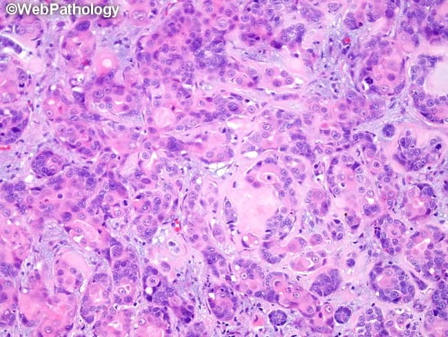 Histology: Light microscopic evaluation of an adenoid cystic carcinoma (ACC) sample, stained with Hematoxylin and Eosin. The tissue shows infiltrative nests and cribriform spaces composed of basaloid myoepithelial-like cells with scant cytoplasm and hyperchromatic, elongated nuclei. A hyalinized basement‑membrane stroma surrounds pseudocystic glandular spaces, producing a characteristic Swiss cheese appearance. Notably, a focal zone demonstrates squamous metaplasia within the tumor and an abrupt dedifferentiation pattern, consistent with high-grade transformation. Perineural invasion is evident in several tumor fronts, explaining potential for extensive local spread. Mitotic activity is variable, with clusters of larger, more pleomorphic cells in the dedifferentiated portion. Overall, the architecture ranges from cribriform and tubular patterns to solid sheets, reflecting the typical heterogeneity of ACC. These features relate to aggressive behavior and a propensity for recurrence after inadequate resection. In context, ACC commonly arises in salivary glands and head‑neck regions and is known for infiltrative margins and nerve tracking. The squamous metaplasia within dedifferentiated ACC carries prognostic significance, suggesting a higher-grade lesion and necessitating multimodal management, including radical surgery with wide margins and adjuvant radiotherapy. Differential considerations include basal cell carcinoma of salivary origin, basaloid squamous carcinoma, and other adenoid cystic variants. This image provides essential learning for recognizing dedifferentiation and perineural spread in ACC.
