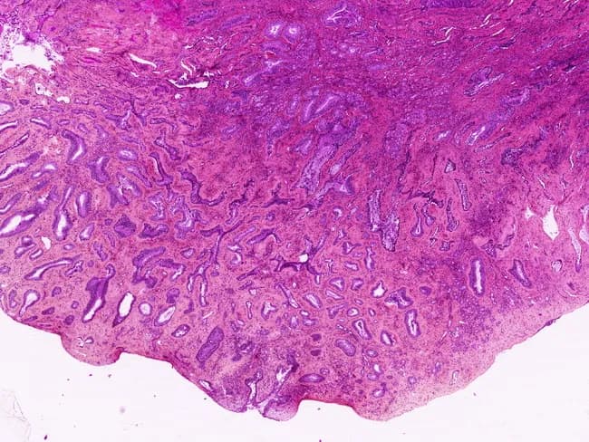 Light microscopy of a hematoxylin-eosin stained nasal polyp from the left nares of a 48-year-old man. Site: nasal cavity with predominant posterior septal involvement. Histology reveals a proliferation of back-to-back glandular spaces lined by ciliated, pseudostratified respiratory epithelium with a continuous basal cell layer. Glands are well differentiated and variably sized, forming tubular to cystic structures embedded in a fibromyxoid stroma. There is no cytologic atypia, mitotic activity, or destructive invasion. Immunohistochemistry shows p63 positivity in basal cells and absence of smooth muscle actin (SMA) labeling in myoepithelial cells, supporting a benign respiratory epithelial adenomatoid hamartoma (REAH). The overall pattern is characteristic of a hamartomatous lesion rather than a true adenocarcinoma, though some discuss its neoplastic relation to low-grade sinonasal adenocarcinoma. Differential diagnosis includes low-grade sinonasal adenocarcinoma, inverted papilloma, and inflammatory polyps; architectural stability and lack of atypia favor REAH. Clinical correlation: this lesion commonly presents with nasal obstruction or polyp formation; treatment is surgical excision with favorable prognosis and low recurrence. Significance: accurate recognition prevents overtreatment, informs prognosis, and guides ENT management. Terminology: REAH, respiratory epithelial adenomatoid hamartoma, nasal glandular hamartoma. This description emphasizes differential diagnosis, immunohistochemical profile, and clinical decision-making in sinonasal glandular lesions.