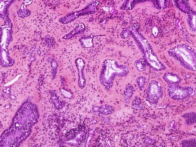 This is a hematoxylin and eosin stained histology image of a sinonasal mucosal lesion evaluated by light microscopy. The specimen is a biopsy/tissue fragment from nasal/paranasal sinus mucosa. The section reveals a network of irregular, gland-forming structures embedded in a fibromyxoid stroma. Glandular lumina vary in size and shape, lined by cuboidal to columnar epithelium with modest basophilic nuclei and scant cytoplasm. Mucin-containing cells or secretory material may be present within luminal spaces. There is a notable absence of overt cytologic atypia or high-grade mitotic activity in this field; no obvious stromal invasion is evident in the captured cortex. Inflammatory cells are scattered, and the architecture shows focal cribriform or tubular patterns consistent with glandular differentiation along Schneiderian mucosa. The histologic differential diagnosis includes intestinal-type adenocarcinoma and other salivary-type adenocarcinomas, as well as inverted papilloma (Schneiderian papilloma) when architectural features and epithelial redundancy are considered. Diagnostic significance rests on distinguishing ITAC from benign/inflammatory sinonasal lesions; immunohistochemistry and clinical context (exposure history, imaging) aid in differential. This image is relevant for surgical pathology, educational histology, and radiologic-pathologic correlation in ENT oncology workups and pathology teaching files. Clinically, it supports multidisciplinary assessment and informs surgical planning and follow-up management for patient care.