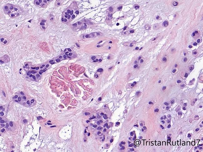 This histopathology image depicts a pleomorphic adenoma of ceruminous gland origin, a rare benign salivary-type mixed tumor arising in the external auditory canal. Acquired via standard bright-field light microscopy, the slide shows Hematoxylin and Eosin staining with widely scattered ductal epithelial structures embedded in a chondromyxoid stroma. The tumor exhibits biphasic cellularity: duct-forming epithelial cells arranged in cords and nests, and intervening myoepithelial/plasmacytoid cells with scant cytoplasm. The stroma is variably myxoid and chondroid, imparting a cartilaginous appearance. In this case, tyrosine-rich crystals are present within the stroma, a distinctive crystalline feature occasionally reported in salivary/glandular myoepithelial lesions. The lesion demonstrates benign histology without significant pleomorphism, mitotic activity, or perineural invasion, supporting a diagnosis of a benign ceruminous pleomorphic adenoma. Clinically, the finding is relevant for differential diagnosis of external auditory canal masses and informs surgical management; complete excision is curative with low recurrence when margins are negative. This image is useful for educational purposes in pathology, ENT, and oral medicine, illustrating the classic histopathological hallmarks: epithelial/myoepithelial biphasic proliferation, chondromyxoid stroma, ductal differentiation, and crystalline deposits, consistent with ceruminous gland-origin pleomorphic adenoma and histologic mimicry to salivary gland pleomorphic adenoma. The image supports diagnostic education in pathology, otolaryngology, and histology.
