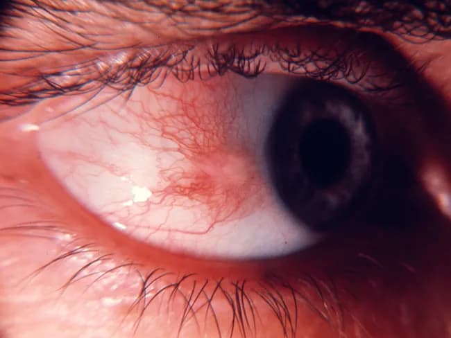 This ophthalmic slit-lamp photograph captures ocular surface of the anterior segment, showing a pinguecula in bulbar conjunctiva adjacent to limbus within the interpalpebral fissure. The lesion appears as a raised, yellow‑white to gray‑white nodule embedded in the superficial stroma of the bulbar conjunctiva, with well‑defined margins and slight smoothing toward the limbus. The surrounding conjunctiva shows normal vascularity and mild surface irritation is absent in this image; no corneal involvement or scleral thinning is evident. Pingueculae represent a degenerative elastotic change of the conjunctival connective tissue, commonly related to cumulative ultraviolet exposure, aging, and environmental factors. The lesion is typically asymptomatic or causes only mild irritation, and it does not progress toward the cornea. Management is usually conservative, consisting of observation and protection from sun exposure; excision is rare and reserved for cosmetic concerns or persistent irritation. Clinically, pinguecula must be differentiated from pterygium, conjunctival nevus, and other conjunctival lesions. This image emphasizes the characteristic location (near the limbus, in the interpalpebral zone), color, and texture without corneal involvement. The diagnostic significance lies in recognizing a benign, UV‑related conjunctival alteration that requires no aggressive treatment unless symptoms or cosmetic issues arise, aiding educational and clinical decision‑making in ophthalmology.