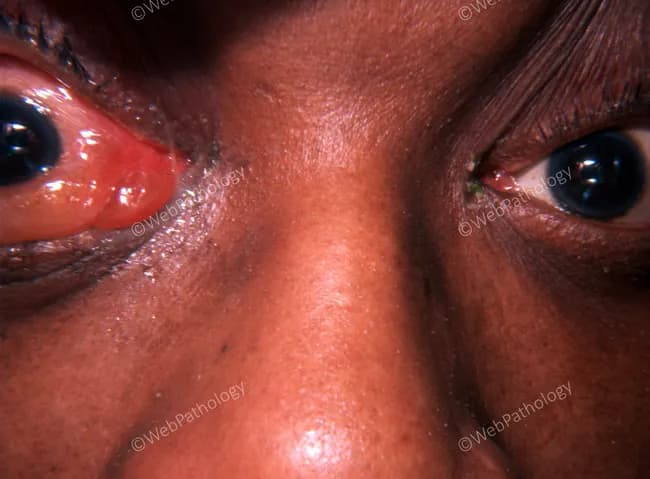 This is a clinical external photograph of the bilateral periorbital region demonstrating signs consistent with orbital cellulitis secondary to ethmoid sinusitis. Modality and technique: Clinical photography (external ocular/adnexal image), frontal view with close-up focus on the orbits, standard color photography under even lighting, with the patient seated. Anatomical context: Orbits and periorbital soft tissues, including eyelids and conjunctiva; medial orbital walls adjacent to the ethmoid sinuses. Visual features: pronounced bilateral periorbital edema and erythema of the eyelids, conjunctival injection, and mild chemosis; proptosis is not clearly evident in this view, though subtle posterior displacement may be present. Pathological interpretation: findings are compatible with orbital cellulitis due to contiguous spread from ethmoid sinus infection; inflammatory edema in the eyelids and orbital soft tissues, with mucosal involvement in the adjacent sinuses. Diagnostic relevance: this pattern signals urgent infectious process requiring prompt systemic antibiotics and imaging to delineate extent and exclude abscess; risk of vision loss and intracranial spread if untreated. Clinical correlation and use cases: useful for ophthalmology and radiology education, differential with preseptal cellulitis, dacryoadenitis, and orbital abscess, and for case-based teaching on sinus-origin orbital infections and emergency management. Early recognition facilitates timely multidisciplinary care and improves visual prognosis.