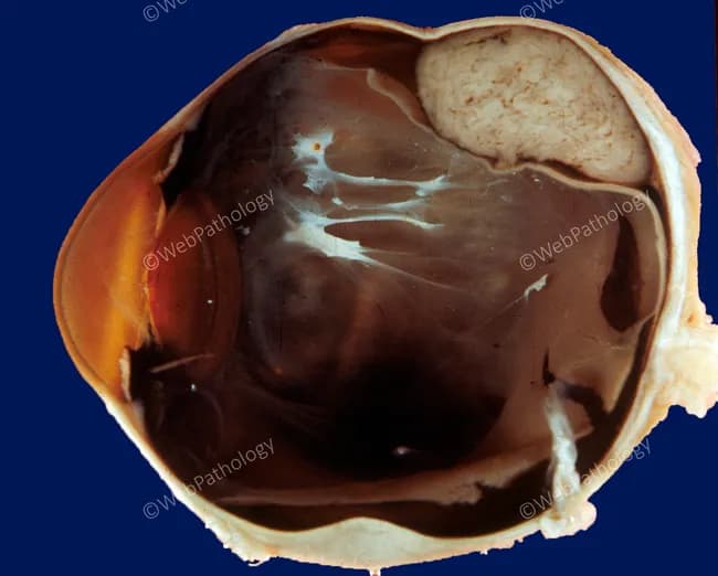 Comprehensive Description: Gross pathology photograph of an enucleated eyeball, oriented in sagittal (anterior–posterior) section. The globe reveals a large, dark brown posterior chamber with exposed sclera and choroid; the retina shows extensive detachment with folded, ribbon-like fibrous membranes extending from the periphery toward the posterior pole. Subretinal white-to-creamy ridges represent fibrous scarring or subretinal exudates. The vitreous cavity is relatively clear in this view, with minimal inflammatory debris; the lens is partially visible on the left, while the optic nerve stump is at the posterior aspect. The anterior segment is not fully captured in this slice. Overall, findings are compatible with advanced rhegmatogenous retinal detachment with secondary fibrovascular proliferation and traction. No acute suppurative endophthalmitis is evident in this section, though chronic inflammatory changes cannot be excluded. The image illustrates disruption of retinal architecture, detachment geometry, and posterior segment pathology that can produce severe, permanent vision loss. Clinically, this supports history of long-standing retinal detachment or intraocular process necessitating enucleation for blind painful eye, trauma, or suspicion of intraocular tumor. Educational relevance includes gross-pathology to histology correlation and informs ophthalmology education, retinal pathology, and surgical decision-making. This image also serves as a teaching aid for histopathology correlation in academic and clinical settings.