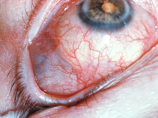 This is a high-resolution anterior segment photograph captured with slit-lamp illumination of the left or unspecified eye (in vivo human eye). The image emphasizes the bulbar conjunctiva and limbal region with diffuse superficial vascular markings. Prominent, fine episcleral vessels are evident over a pale, yellow-white patch at the nasal bulbar conjunctiva adjacent to the corneal limbus, consistent with a pinguecula. The scleral tissue surrounding the patch remains visible through thin overlying conjunctiva, and the cornea shows clear transparency with no evident stromal scar or infiltrate. Iris color is blue in this view; the pupil is centered. There is mild conjunctival injection and mild chemosis near the inferior fornix, but the central cornea is unremarkable. The lesion does not appear vascularized or ulcerated and does not encroach onto the corneal surface in this image. Overall, the pattern suggests a degenerative, sun-exposure-related matrix change in the bulbar conjunctiva. Diagnostic relevance includes differentiating pinguecula from pterygium and from inflammatory conjunctival processes. This image is suitable for educational demonstrations of anterior segment anatomy, ocular surface pathology, and clinical differential diagnoses in ophthalmology, dermatology–ophthalmology interface, and medical student teaching. Recommends clinical correlation and follow-up if symptoms worsen.