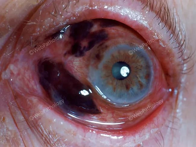 Imaging modality: Anterior segment photography of the left eye using slit-lamp ophthalmic photography. The technique provides a high‑resolution frontal view of the anterior segment, including the cornea, iris, pupil, and sclera. The image shows a blue iris with a brown‑black pigmented lesion occupying a sector of the iris, with irregular, ill‑defined margins extending toward the pupillary zone. The surrounding iris stroma is variably depigmented, and the pupil remains round with a bright reflected light source. Conjunctival and episcleral vessels are mildly congested inferiorly, with subtle conjunctival injection. There is no obvious corneal opacity or lens opacity. The lesion appears confined to the iris with partial involvement of the pupillary border; there is no visible transillumination defect. The differential diagnosis includes iris nevus and iris melanoma; characteristic features to assess include progression in size, thickness, surface nodularity, iridocorneal angle involvement, and secondary glaucoma risk. This image is valuable for education in recognizing unilateral pigmented iris lesions, establishing baseline documentation for surveillance, and guiding clinical decision making about monitoring versus biopsy or surgical intervention. Clinically, this finding warrants ophthalmology referral for slit-lamp examination and anterior segment imaging, with AS-OCT or ultrasound biomicroscopy to determine lesion characteristics and growth over time. Potential uses include medical education, case repositories, diagnostic reasoning, and surveillance planning.