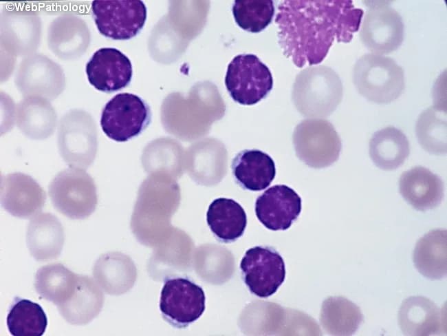 Peripheral blood smear from a patient with suspected chronic lymphocytic leukemia (CLL) shows a predominance of small, mature-appearing lymphocytes with scant cytoplasm and clumped nuclear chromatin, accompanied by fragile cells that readily disrupt during smear preparation, producing numerous smudge or basket cells visible on the slide. The image depicts a single smudge cell in the upper right, with numerous small darkly staining lymphocytes occupying the field. The smear was prepared with Wright-Giemsa stain and examined under light microscopy at high magnification (approximately 1000x total magnification with oil immersion). Clinically, CLL is defined by absolute mature lymphocytosis of ≥5.0 × 10^9/L sustained for ≥3 months, often asymptomatic and detected incidentally on complete blood count. Morphology alone is insufficient for diagnosis; immunophenotyping showing co-expression of CD5, CD19, CD23 with weak surface immunoglobulin and light chain restriction supports CLL diagnosis. Smudge cells result from fragile leukemic cells and reflect underlying cytoskeletal fragility, though they are not specific. The image illustrates typical features: monomorphic lymphocytes, scant cytoplasm, condensed chromatin, and absent prominent nucleoli. This finding has diagnostic significance, guiding further workup, including flow cytometry, cytogenetics, and molecular studies, to distinguish CLL from other chronic lymphoproliferative disorders such as small lymphocytic lymphoma (SLL), mantle cell lymphoma, prolymphocytic leukemia, and reactive lymphocytosis.