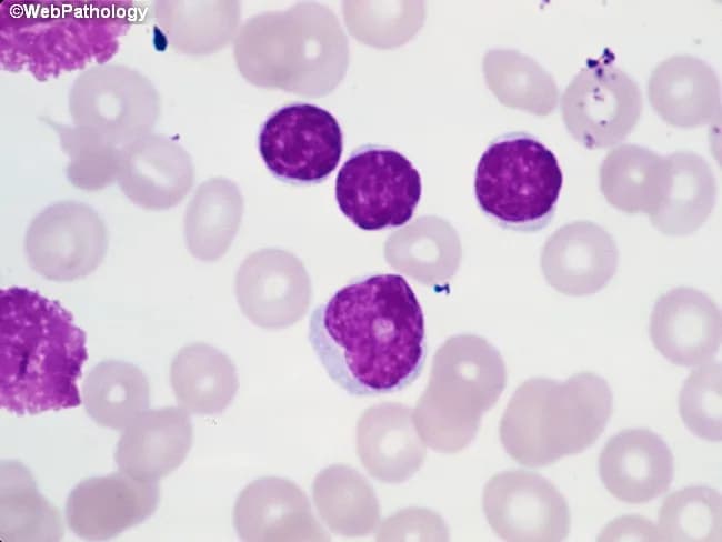 Imaging Modality: Brightfield light microscopy of a Wright-Giemsa stained peripheral blood smear. The primary subject is leukocytes from circulating blood, with focus on small mature-appearing lymphocytes and rare prolymphocytes. At center-right, several lymphocytes exhibit condensed chromatin and scant cytoplasm, consistent with chronic lymphocytic leukemia (CLL) morphology. Along the left edge, characteristic smudge cells are visible, reflecting fragile lymphocytes commonly seen in CLL. A prolymphocyte located just below center presents with slightly irregular nuclear contours, more dispersed chromatin, a prominent nucleolus, and modestly increased cytoplasm. In CLL, prolymphocytes usually comprise less than 2% of neoplastic cells; when 10–15%, the term atypical CLL is used and carries implications of aberrant immunophenotype, cytogenetic abnormalities, cytopenias, refractoriness to therapy, and worse prognosis. If prolymphocytes predominate, consideration should be given to B-cell prolymphocytic leukemia. This image demonstrates key diagnostic features including lymphoid morphology, prolymphocytic variant, and smear artifacts. Clinically, these findings correlate with lymphocytosis and potential anemia or thrombocytopenia in affected patients. Definitive characterization requires ancillary testing such as flow cytometry, immunophenotyping, and cytogenetics. The morphology supports a differential diagnosis that includes CLL with prolymphocytic transformation, atypical CLL, and B-PLL, guiding prognosis and treatment planning.
