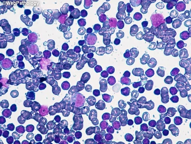 Imaging modality: Brightfield light microscopy of a Wright-Giemsa stained peripheral blood smear. The slide shows a predominant population of small to medium-sized lymphoid cells with scant pale cytoplasm and dense, clumped chromatin. Numerous cells exhibit mature-appearing B lymphocyte morphology. A fine background of erythrocytes and occasional smudge cells is present, with no overt blasts or granulocytic abnormalities. The overall pattern is lymphocytosis with a monomorphic lymphocytic population, compatible with monoclonal B-cell lymphocytosis (MBL) or the chronic lymphocytic leukemia (CLL) spectrum. Immunophenotypic confirmation (CD5+, CD23+, CD19+, surface Ig) is typically required for definitive classification, but is outside the scope of this image. The cluster appears relatively uniform, suggesting clonality rather than reactive lymphocytosis. Genetic associations commonly reported with CLL/MBL include 13q14 deletion and trisomy 12, though such findings require molecular testing. Clinically, CLL is defined by an absolute lymphocyte count ≥5.0 x 10^9/L in peripheral blood for at least 3 months; values below this threshold meet criteria for MBL. The image illustrates morphologic correlates of indolent clonal B-cell expansions and underscores the need to integrate flow cytometry and cytogenetics for diagnosis, prognosis, and management decisions. This image is educational for hematology, pathology, and cytology reference libraries.