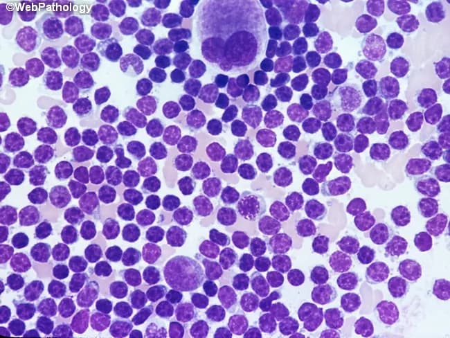 Bone marrow aspirate smear analyzed by light microscopy with high magnification reveals marrow involvement by chronic lymphocytic leukemia (CLL) cells. The predominant population consists of small, dark lymphocytes with scant cytoplasm and condensed, clumped nuclear chromatin, producing high nuclear-to-cytoplasmic ratios. Occasional larger forms and prolymphocytes may be present but are uncommon. A consistent finding is the relative scarcity of cytoplasm and uniform round to slightly irregular nuclei among the bulk of lymphoid cells. The smear may show scattered megakaryocytes, reflecting concurrent hematopoietic activity within the aspirate. Morphology mirrors circulating leukemic cells, consistent with systemic disease. Clinically, such marrow infiltration is associated with cytopenias and advanced disease stage, especially when diffuse, solid infiltration predominates in core biopsy patterns; these patterns correlate with adverse prognosis and with expression of prognostic markers such as ZAP-70. The image corresponds to a high-magnification field intended to document cellular detail rather than architectural marrow patterns. Diagnostic significance lies in confirming lymphoid marrow involvement by CLL, quantifying blast equivalents is not applicable, and differentiating from other small B-cell neoplasms relies on adjunct flow cytometry, cytogenetics, and immunophenotyping. This representation is typical for educational, diagnostic, and research contexts describing CLL marrow morphology.