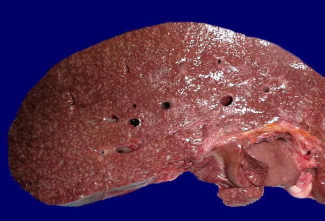 This gross pathology image depicts a human liver from an autopsy with chronic lymphocytic leukemia (CLL). The hepatic parenchyma bears numerous small whitish‑gray nodules scattered throughout the entire cut surface, corresponding to leukemic infiltrates concentrated in periportal areas. Macroscopically the nodules are subtle but conspicuous against the usually uniform red-brown background of healthy liver tissue. The periportal pattern reflects infiltration along portal tracts and within the surrounding lobular parenchyma, a recognized histopathologic correlate of CLL involvement. The liver is part of a disseminated leukemic process, as indicated by concurrent involvement of bone marrow, lymph nodes, spleen, and kidneys in this case, consistent with advanced systemic disease. The autopsy specimen provides direct visualization of organomegaly and parenchymal replacement by malignant lymphocytes, which may contribute to hepatic dysfunction in late-stage disease. Clinically, such hepatic infiltration can manifest as hepatomegaly, cholestasis, or cytopenias secondary to marrow failure. For education and research, this image illustrates an end-stage pattern of CLL hepatic involvement, helps differentiate lymphoid infiltration from focal hepatic metastases, and supports teaching about organ-wide dissemination. Note: image is a gross specimen photograph with a blue backdrop, illustrating macroscopic periportal nodularity and leukemic spread.