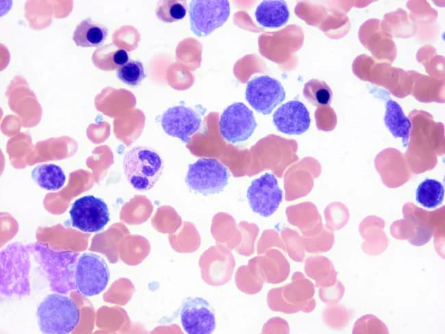 This image depicts a peripheral blood smear prepared with Wright-Giemsa stain and examined under light microscopy at high magnification. The predominant features are small, mature-appearing lymphocytes with scant cytoplasm and discrete basophilic nuclei interspersed among erythrocytes. A characteristic subset of circulating lymphocytes displays short, polarity-restricted cytoplasmic villi (finger-like projections) consistent with splenic marginal zone lymphoma (SMZL) involvement of peripheral blood. The villi are typically slender and localized to one pole of the cell, unlike the longer, circumferential villous extensions seen in hairy cell leukemia, which aids in differential diagnosis. Some lymphocytes appear slightly irregular or irregular nuclear contours; occasional larger atypical cells may be present but are less common. The background shows normocytic red cells with normal distribution; platelets are not prominent. This cytomorphology supports SMZL in the context of known splenomegaly or lymphoproliferative disease and is often corroborated by immunophenotyping and molecular studies. Clinically, peripheral blood involvement occurs in roughly half to two-thirds of SMZL cases and helps establish disease burden. The image illustrates the diagnostic utility of meticulous peripheral smear review for small-vessel lymphocytosis and villous lymphocytes, informing differential diagnoses, guiding flow cytometry panels, and contributing to monitoring and prognosis.