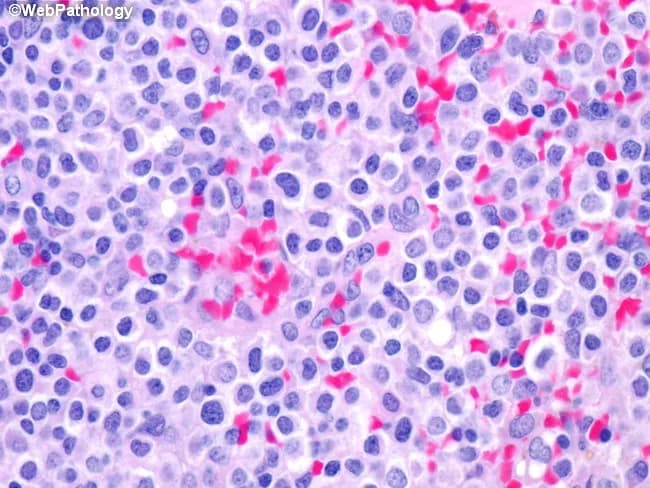 High-magnification bright-field light microscopy of a bone marrow hematopoietic smear stained with hematoxylin and eosin reveals a monotonous population of hairy cells adjacent to blood lakes. The neoplastic cells are uniform in size, with round to oval nuclei and inconspicuous nucleoli, and abundant clear cytoplasm creating the classic fried-egg appearance around the nucleus. Cytoplasmic projections (hair-like processes) may be subtle at this magnification but contribute to the characteristic 'hairy' cytology. The background shows scattered erythroid and myeloid cells with preserved but reduced overall marrow cellularity; focal vascular spaces appear as pink blood lakes infiltrated by neoplastic cells. The cells display minimal nuclear atypia, fine chromatin, and a low mitotic rate, consistent with a mature B-cell neoplasm. Immunophenotypic hallmarks, when tested, typically include CD11c, CD25, and CD103 positivity, with BRAF V600E mutation supporting diagnosis of hairy cell leukemia. Clinically, such marrow infiltration can cause cytopenias and splenomegaly; the morphological pattern is critical for prompt diagnosis and to guide targeted therapy (e.g., purine analogs, BRAF inhibitors). This image exemplifies the classic marrow involvement, providing a valuable reference for hematopathology education, differential diagnosis, and histomorphology training in leukemic lymphoid proliferations. Educationally, it reinforces recognition of distinct cytoplasmic clearing and nuclear features for learners.
