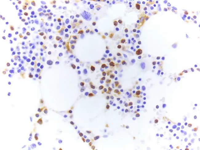This histology image depicts a tartrate-resistant acid phosphatase (TRAP) stained smear from a bone marrow aspirate in hairy cell leukemia (HCL). The modality is bright-field microscopy. Hairy cell leukemia is a B-cell neoplasm characterized by bone marrow infiltration with mononuclear cells possessing delicate, cytoplasmic, hair-like projections. In TRAP cytochemistry, neoplastic cells exhibit red granular cytoplasmic staining due to tartrate-resistant acid phosphatase activity, a classic diagnostic feature; modern practice often relies on TRAP immunohistochemistry (IHC), which produces brown cytoplasmic positivity but is less specific than the cytochemical method. The image demonstrates scattered medium-to-large cells with abundant cytoplasm and fine cytoplasmic extensions, interspersed among normal hematopoietic elements and adipocytes; many cells show prominent TRAP positivity. Because TRAP activity is labile, slides must be air-dried and stained promptly after preparation. In this example, TRAP IHC has been applied, highlighting hairy cells with cytoplasmic labeling; however, positivity may be observed in other B-cell neoplasms, so interpretation should be integrated with morphology and immunophenotyping (e.g., CD11c, CD25, CD103). Clinically, HCL presents with cytopenias, splenomegaly, and marrow fibrosis; accurate histopathologic diagnosis informs targeted therapy with purine analogs and informs prognosis. This image is educational for hematopathology, cytochemistry, and diagnostic immunohistochemistry practice.