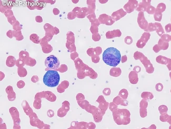This is a peripheral blood smear prepared with Wright-Giemsa stain and examined under brightfield illumination at high magnification (approximately 1000x total, 100x objective with oil immersion). The smear displays predominantly erythrocytes with uniform pink cytoplasm and characteristic biconcave morphology, arranged singly with occasional rouleaux. Interspersed among the red cells are leukocytes with visible nuclei. Notably, two large lymphocyte-like cells or mononuclear leukocytes appear conspicuously larger than surrounding erythrocytes; these cells have round to oval, deeply basophilic nuclei with dense chromatin and scant, lightly basophilic cytoplasm. No visible granulocytic cytoplasm granules or multiple lobes are clearly resolved in this field, and there are no obvious nucleoli or cytoplasmic inclusions evident in these cells. The background lacks abnormal pigment or reticulocytosis. Overall cell morphology is consistent with a normal or mildly reactive hematologic smear; in a clinical context, additional data such as complete blood count, differential, and patient history would be needed to determine whether there is leukocytosis or blasts. This image serves as an educational reference for recognizing basic peripheral blood components, evaluating leukocyte size variation, and assessing RBC morphology for hematology training and diagnostic differential diagnoses. Additional cases and image contexts can reinforce recognition of hematologic normal variants and patterns.