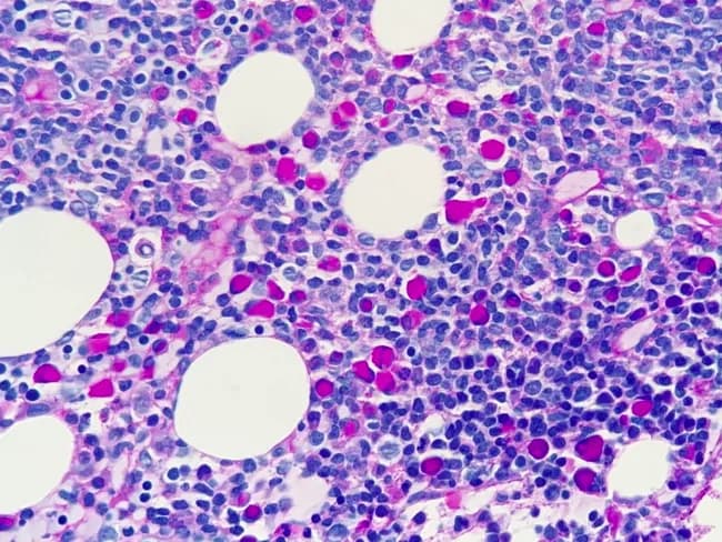 This is a bone marrow biopsy/section analyzed by light microscopy using Periodic acid–Schiff (PAS) stain. The image shows marrow with lymphoplasmacytic infiltration including malignant plasma cells. Dutcher bodies are intranuclear immunoglobulin inclusions that stain PAS-positive, appearing as rounded, eosinophilic or magenta inclusions within the nucleus of plasma cells. The plasma cells display eccentric nuclei and basophilic cytoplasm. The overall architecture shows a hypercellular marrow with scattered adipocytes; residual hematopoietic cells vary between small lymphocytes and plasmacytoid cells. The PAS stain highlights the Dutcher bodies and cytoplasmic granularity, aiding identification of plasma cell involvement. In Lymphoplasmacytic lymphoma, marrow involvement is common with clonal expansion of small mature lymphocytes, plasmacytoid cells, and plasma cells. Diagnostic significance lies in recognizing Dutcher bodies as a clue to immunoglobulin production within malignant plasma cells; the PAS positivity helps differentiate from non-plasmacytoid marrow processes. Potential clinical use cases include confirming marrow involvement in suspected Waldenström macroglobulinemia, assessing tumor burden, monitoring response to therapy, and guiding differential diagnoses such as marginal zone lymphoma or multiple myeloma. Given the PAS staining pattern and Dutcher bodies, this image is especially relevant for hematopathology education, marrow pathology case repositories, and histology atlases.