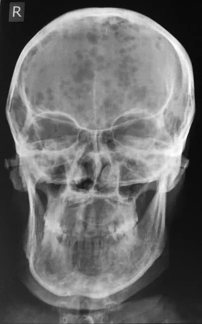 This skull radiograph illustrates findings typical of plasma cell myeloma. Modality: plain skull X-ray (radiography); view: frontal skull projection, with the right side marker visible. The calvarium shows multiple small, uniform, sharply demarcated punched-out lytic lesions throughout the cranial bones, without a sclerotic rim or periosteal new bone formation. In several regions, the lesions extend toward the mandible, reflecting medullary bone destruction with cortical involvement in advanced sites. Generalized osteopenia is evident, resulting in diffuse reduced bone density beyond the focal lucencies. There is no visible acute fracture or reactive sclerosis. The pattern—punched-out lacunae in a background of osteopenia—is highly suggestive of multiple myeloma and is more typical of plasma cell neoplasms than osteoblastic metastases. Clinically, the patient presented with weakness, fatigue, backache, weight loss, and anemia, consistent with CRAB features (hypercalcemia, renal impairment, anemia, bone lesions). The imaging supports differential considerations including metastatic disease and Langerhans cell histiocytosis, but the distribution and appearance favor a myelomatous process. This radiograph provides visual corroboration for staged disease assessment and guides further diagnostics (MRI/CT, skeletal survey, serum protein electrophoresis, bone marrow biopsy). Case courtesy of Radiopaedia, rID 40195. The image exemplifies classic myeloma-related skeletal destruction and underscores the importance of early oncologic workup.