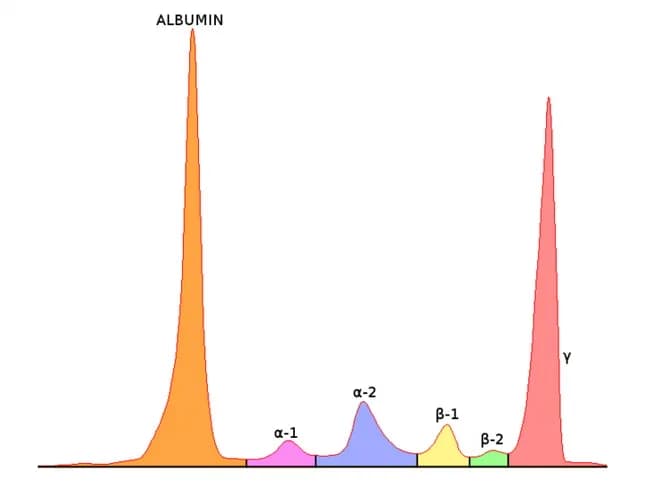 Serum Protein Electrophoresis (SPEP) with immunofixation is depicted as a schematic distribution of serum proteins into discrete zones. The illustration emphasizes the gamma region where a monoclonal M component appears as a narrow, sharp spike in patients with plasma cell disorders, contrasted with the broad, polymorphic gamma background of polyclonal immunoglobulins. In clinical practice, an M component is first detected on SPEP and then characterized by immunofixation electrophoresis (IFE), which uses specific antisera against heavy chains (IgG, IgA, IgM, IgD, IgE) and light chains (kappa, lambda) to identify the M protein type and light chain restriction. The most frequent M component is IgG (~50%), followed by IgA (~20%), light-chain only (~20%), and rare IgD/IgE/IgM or biclonal cases (~1–2%). The total immunoglobulin level rises because of the M protein, often with suppression of normal polyclonal immunoglobulins and albumin. IFE detects the M component in serum or urine in about 97% of secretory myelomas; non-secretory disease or certain heavy/light chain combinations may yield undetectable M bands. Clinically, the M component supports diagnosis of plasma cell dyscrasias (multiple myeloma, MGUS, smoldering MM), informs prognosis, guides therapy, and enables longitudinal monitoring of tumor burden and response. Educationally, this image illustrates the concept of a monoclonal spike versus a polyclonal background, the sequential use of SPEP followed by IFE, and the utility of serum and urine testing to capture secretory versus non-secretory variants.