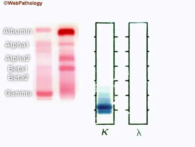 This bipartite laboratory image shows serum protein electrophoresis (SPEP) on the left and urine protein electrophoresis (UPEP) on the right from a patient with plasma cell myeloma. The left panel reveals a sharp monoclonal spike in the gamma region (M component); immunofixation identifies it as IgG kappa. There is suppression of albumin and polyclonal immunoglobulins, producing a disrupted background. The normal serum control lane (red) displays the expected thick albumin band at the top, followed by alpha1, alpha2, beta1, beta2, and a discrete gamma band; by contrast, the patient’s serum lane shows a prominent monoclonal gamma band with diminished other bands. The right panel shows urine electrophoresis with free kappa light chains (Bence-Jones proteins) detected, reflecting light-chain predominance in urine that may be reabsorbed by proximal tubules and may be absent if renal function is intact. In myeloma, the M component is commonly IgG (~50%), followed by IgA (~20%), with rare IgM, IgD, or IgE. About 20% have only free light chains without serum M-protein; ~3% are non-secretory. Excess immunoglobulins can cause hyperviscosity. These patterns aid diagnosis, prognosis, and monitoring response to therapy, including serial SPEP/UPEP and immunofixation, and guide further workup such as bone marrow biopsy and renal assessment.