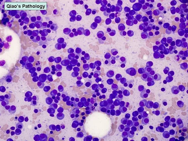 Bone marrow aspirate smear prepared with Wright-Giemsa stain was examined under light microscopy at 40X magnification. The smear demonstrates plasmacytosis with elevated plasma cells, comprising roughly 20% to 35% of nucleated cells in most cases of myeloma; in some preparations the marrow is nearly devoid of other hematopoietic elements due to extensive plasma cell replacement. Morphology spans the spectrum from mature, normal-appearing plasma cells to highly atypical plasmablasts. Mature cells show round to oval nuclei with clumped coarse chromatin and inconspicuous nucleoli; plasmablasts exhibit dispersed chromatin, prominent single nucleolus, and higher nuclear-to-cytoplasmic ratio. The cellular distribution may be diffuse or vaguely patterned with small clusters. This cytologic profile underpins the classification of myeloma variants into mature, intermediate, immature, and plasmablastic forms. Plasmablastic myelomas tend to be highly aggressive, with a poorer prognosis and median survival often less than one year, underscoring the clinical significance of morphologic assessment for risk stratification and treatment planning. The Wright-Giemsa preparation highlights cytoplasmic basophilia, nuclear pleomorphism, and mitotic activity in aggressive foci. This image provides a classic representation of plasmacytosis within marrow, illustrating the diagnostic importance of cellular morphology in multiple myeloma, plasmacytoma, and related plasma cell dyscrasias.