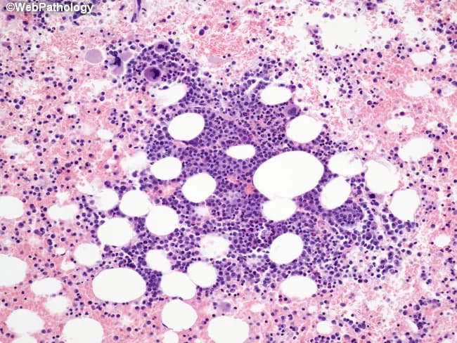 Bone marrow trephine biopsy prepared for light microscopy and stained with hematoxylin and eosin. The specimen shows bone trabeculae with islands of immature plasma cells dispersed within a background of normal hematopoiesis. In this case, multiple focal lesions are present, reflecting variable tumor burden and disease stage. The neoplastic plasma cells demonstrate a high nuclear-to-cytoplasmic ratio, round to oval nuclei, finely dispersed chromatin, and conspicuous nucleoli. Cytoplasm is scant, and some cells exhibit a plasmacytoid appearance consistent with early myeloma biology. The tumor islands are irregularly distributed and interposed between erythroid, myeloid, and megakaryocytic cells, indicating patchy infiltration rather than uniform replacement. Some large aggregates create focal crowding but do not completely efface the marrow architecture. Mitoses are infrequent in this field. The surrounding hematopoietic marrow appears variably preserved, with preserved megakaryopoiesis in residual areas. These histologic features are compatible with a plasma cell neoplasm and are typical of multiple myeloma in a relatively early focal stage, where trephine sampling may underrepresent overall tumor burden. Clinically, such findings correlate with laboratory monoclonal protein, skeletal surveys, and marrow plasma cell percentage for staging (ISS/RA). The described morphology supports diagnosis and informs prognosis, risk stratification, and treatment decisions in plasma cell myeloma.
