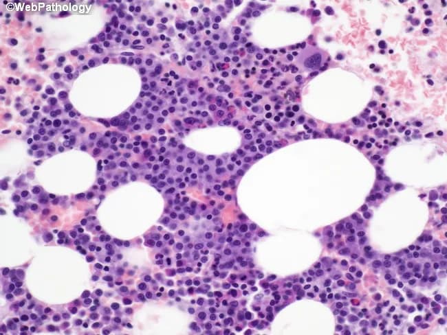 Imaging modality and technique: light microscopy of an H&E stained bone marrow trephine biopsy, demonstrating focal clusters of immature plasma cells within otherwise normal hematopoietic marrow. Primary subject: multiple myeloma plasma cell neoplasm with focal involvement in the marrow rather than uniform infiltration. Specimen: bone marrow biopsy core from iliac crest; perspective: microscopic cellular detail. Visual features: islands of small, tightly packed cells with oval to irregular nuclei, scant cytoplasm, condensed chromatin, and occasional prominent nucleoli; cytoplasm scant but adequate for recognition of plasma cell lineage. Surrounding marrow shows preserved hematopoiesis with trilineage elements; no overt osteoid or fibrotic bands described. Pathology: tumor cells exhibit high nuclear-to-cytoplasmic ratio and dysplastic, immature morphology; dispersed chromatin; some cells with conspicuous nucleoli; distribution irregular, with patches of tumor cells separated by intervening normal marrow. Diagnostic significance: histologic pattern supports early/patchy marrow involvement by plasma cell neoplasm, consistent with multiple myeloma; sampling error is possible in focal disease, emphasizing the need for regional marrow sampling and integration with ancillary studies (flow cytometry, immunoglobulin studies, cytogenetics). Clinical relevance: correlates with systemic disease burden, guides staging, prognosis, and treatment planning; spatial heterogeneity underscores importance of comprehensive marrow evaluation for monitoring response and minimal residual disease assessment.