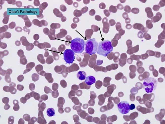 Peripheral blood smear prepared from a patient with suspected plasma cell leukemia (PCL) was examined by bright‑field light microscopy after Wright‑Giemsa staining. The smear shows several circulating plasma‑cell–like elements, including four conspicuous proplasmacytes with dispersed nuclear chromatin and prominent nucleoli, as indicated by arrows in the original figure. In addition, background erythrocytes exhibit rouleaux formation, a common feature in paraproteinemic states. The cells display eccentrically placed nuclei with pronounced basophilic cytoplasm and a coarse chromatin pattern; occasional cells show a perinuclear clearing (Golgi rim) suggestive of plasmacytic differentiation. Immunoglobulin light‑chain restriction is not determined on this smear alone but flow cytometry or immunohistochemistry would typically confirm clonal plasma cells. Relative proportions indicate that neoplastic plasma cells constitute a substantial fraction of leukocytes, consistent with plasma cell leukemia rather than reactive plasmacytosis. PCL is an aggressive myelomatous process often presenting with cytopenias, organomegaly, and sometimes lymphadenopathy; prognosis is poor, and treatment responsiveness is limited. This image illustrates characteristic morphologic features used for differential diagnosis against multiple myeloma, Waldenström macroglobulinemia, and other causes of plasmacytosis. Clinically relevant keywords include plasma cells, rouleaux, Wright‑Giemsa stain, 100X oil, peripheral blood, leukemia, myeloma, and hematologic malignancy.