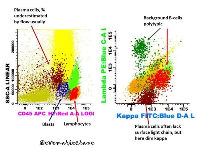 Multiparameter flow cytometry immunophenotyping of bone marrow plasma cells demonstrates clonal kappa-restricted population consistent with plasma cell myeloma. Gating on CD45, CD38, and CD138 identifies plasma cells, which reveal dim surface kappa light chain expression while cytoplasm shows bright kappa positivity; normal/reactive plasma cells display polyclonal cytoplasmic immunoglobulins and lack overt surface light chain restriction. The left panel illustrates plasma cells with a typical myeloma phenotype (CD45 dim, CD38 high, CD138 positive) against a background of polyclonal B cells and blasts; the right panel highlights the clonal kappa-restricted cluster, with dim surface κ but strong cytoplasmic κ staining, contrasting with lambda-restricted or kappa-negative populations. These features support clonality and enable minimal residual disease assessment after therapy. The assay complements morphology and serum paraprotein studies by providing quantitative, single‑cell sensitivity to detect residual malignant plasma cells below conventional thresholds. Diagnostic significance lies in confirming clonal plasma cell dyscrasia and guiding therapeutic decisions, prognosis, and MRD-directed treatment intensity. Normal variants include polyclonal plasma cells and non-neoplastic B cells, which serve as internal controls. Differential considerations include reactive plasmacytosis with polyclonal light chains and small clonal expansions. Clinically, flow cytometry MRD monitoring informs response assessment, risk stratification, and potential relapse prediction in multiple myeloma.