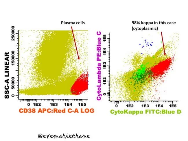 Flow cytometry immunophenotyping of a hematologic specimen reveals clonal plasma cell proliferation consistent with a plasma cell neoplasm. In the left panel, CD38 APC:Red-A log versus SSC-A linear delineates a large, bright CD38-positive plasma cell gate, marked by a dense cluster at higher CD38 intensity and substantial forward and side scatter typical of plasma cells. The right panel demonstrates intracellular light-chain analysis with CytoKappa FITC:Blue D versus Ig light chain axis, showing a dominant κ-restricted subset comprising the vast majority of κ-positive events (approximately 98%), with minimal λ-expressing cells. The data indicate strong cytoplasmic κ light-chain expression while surface immunoglobulin is absent or markedly reduced on these neoplastic cells, supporting clonality. CD138 is strongly expressed, consistent with plasmacytic differentiation. The observed immunophenotype, including CD38 bright and CD138 positivity with κ light-chain restriction, favors a malignant plasma cell process over reactive plasmacytosis. Additional markers commonly described in myeloma panels (e.g., CD19 negative/dim, CD56 variable) may be inferred but are not shown. Clinically, this pattern is critical for classification, diagnostic confirmation of plasma cell dyscrasia, and monitoring via minimal residual disease assessment, guiding staging and therapeutic decisions. This annotation is suitable for educational databases and clinical decision-support tools in hematology and research.
