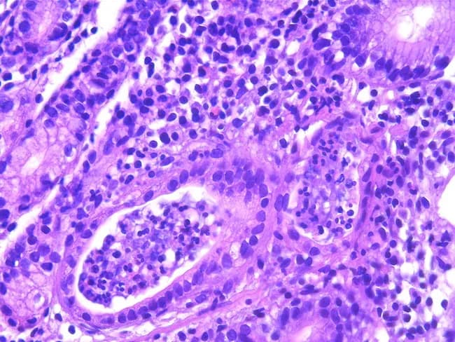 This histopathology image shows gastric mucosa with chronic active gastritis. Hematoxylin and eosin (H&E) staining reveals dense lymphoplasmacytic infiltrate in the lamina propria surrounding gastric glands, with crypt abscess formation and neutrophilic cryptitis. Epithelial architecture is variably preserved, but focal glandular distortion and inflammatory debris are evident. There is a prominent inflammatory milieu dominated by mature lymphocytes and plasma cells, consistent with a chronic inflammatory process, and occasional eosinophils are present. The image is contextually linked to Helicobacter pylori infection, which is identified in a subsequent Giemsa-stained preparation in most cases and is a key driver of acquired MALT in the stomach. Gastric mucosa in H. pylori-associated gastritis may harbor mucosa-associated lymphoid tissue (MALT) and can evolve toward MALT lymphoma in rare cases. Clinically, such findings warrant H. pylori testing and eradication therapy, since antibiotic treatment often induces remission in gastric MALT lymphoma and reduces cancer risk. This field illustrates the histologic substrate for chronic inflammation and B-cell-mediated lymphoid responses; correlation with clinical data, endoscopy, and ancillary studies (immunohistochemistry, molecular tests) is essential for accurate diagnosis and management decisions. The image is suitable for teaching histology of gastritis, differential diagnosis of gastric ulcers, and evaluation of H. pylori-related MALT pathology in practice.