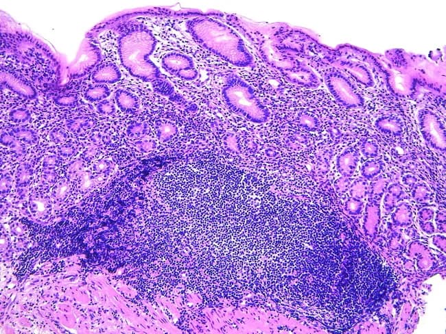 Gastric biopsy histology showing acquired MALT following Helicobacter pylori infection. Hematoxylin and eosin stained sections reveal dense lymphoid infiltration in the lamina propria with formation of lymphoid aggregates and germinal centers, partially effacing normal mucosal architecture. The overlying gastric epithelium remains intact in areas, but lymphoepithelial lesions may be present, indicating invasion of ducts or epithelium by neoplastic B-cells. The stomach normally lacks organized lymphoid tissue; the observed lymphoid proliferation represents mucosa-associated lymphoid tissue expansion, consistent with extranodal marginal zone B-cell lymphoma of mucosa-associated lymphoid tissue (MALT lymphoma). The cellular population is typically small to medium-sized lymphocytes with irregular chromatin, sometimes with plasmacytoid differentiation; scattered immunoblasts may occur. Chronic inflammation, such as Helicobacter pylori gastritis, provides the antigenic stimulus driving MALT development and potential regression after microbial eradication. Clinically, MALT lymphoma of the stomach may respond to antibiotic therapy, with lesion regression upon H. pylori eradication, or require staging and systemic therapy if refractory or advanced. Differential includes reactive lymphoid hyperplasia and transformation to diffuse large B-cell lymphoma. Diagnostic significance lies in recognizing MALT patterns to guide treatment, prognosis, and surveillance; correlate with endoscopic findings and serology for infection status.