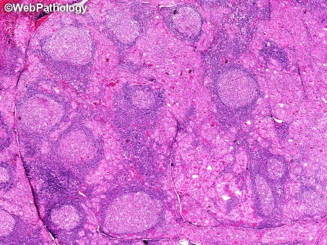 Light microscopy of thyroid tissue prepared with Hematoxylin and Eosin (H&E) staining shows features consistent with Hashimoto thyroiditis. The specimen arises from the thyroid gland in the cervical region. The slide demonstrates diffuse lymphocytic infiltration with formation of enlarged lymphoid follicles bearing prominent germinal centers, a hallmark of autoimmune thyroiditis. Interspersed are residual thyroid follicles that are small and atrophic, many lined by oncocytic (Hürthle) cells with abundant granular eosinophilic cytoplasm. The architectural disruption of normal thyroid parenchyma and the presence of germinal center-rich lymphoid infiltrates reflect chronic inflammation. These histologic features are classic for Hashimoto thyroiditis and are associated with an increased risk of secondary thyroid lymphoma, notably diffuse large B-cell lymphoma (DLBCL) comprising the majority of lymphomas in this setting, with mucosa-associated lymphoid tissue (MALT) lymphoma accounting for a smaller but meaningful fraction. The image highlights autoimmune etiologies and potential malignant transformation. Clinically, such histology supports autoimmune hypothyroidism in many patients and warrants surveillance for lymphoma development. Diagnostic significance includes correlation with serology (anti-thyroid peroxidase antibodies) and thyroid function tests, and may guide therapeutic decisions, including consideration of targeted biopsy in suspicious cases. These features aid educational teaching and differential diagnosis for pathology trainees in practice and research.