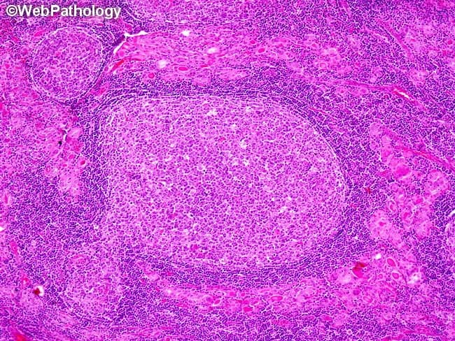Imaging modality: Light microscopy of thyroid tissue; Hematoxylin and eosin stained; 400x magnification. The specimen shows thyroid parenchyma with dense mononuclear inflammatory infiltrate. There are well-developed germinal centers within lymphoid follicles indicating lymphoid folliculopathy; the normal thyroid follicles are small and atrophic and exhibit prominent Hurthle cell (oxyphilic) change with abundant granular eosinophilic cytoplasm. The interface between infiltrate and residual follicles is irregular; the architecture is disrupted with loss of colloid and follicular cell atrophy. The infiltrate is predominantly lymphocytic with plasma cells; occasionally macrophages; formation of organized lymphoid follicles suggests autoimmune thyroiditis. Clinically Hashimoto's disease is associated with anti-thyroid antibodies (anti-TPO, anti-thyroglobulin); this histology correlates with autoimmune hypothyroidism in adults, typically female, around age 60; pediatric cases occur. The diagnostic significance lies in identifying chronic lymphocytic thyroiditis and distinguishing from acute or granulomatous thyroiditis; Hashimoto's increases risk for thyroid lymphoma (MALT, diffuse large B-cell). Differential considerations include subacute thyroiditis, de Quervain's granulomatous thyroiditis, and radiation-induced changes. This image exemplifies classic Hashimoto histopathology: lymphoid follicle formation, Hurthle cell metaplasia, and thyroid parenchymal destruction. Potential clinical applications include educational reference for medical students and residents, differential diagnosis practice, and correlation with serologic autoimmune markers (anti-TPO, anti-Tg) and hypothyroid management.