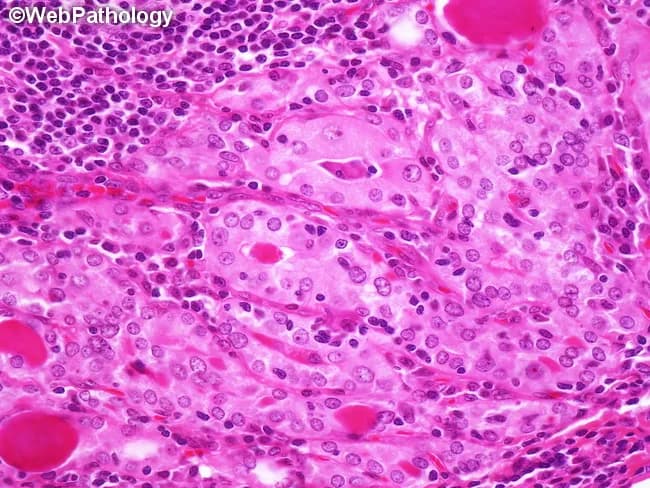Bright-field light microscopy of thyroid tissue stained with Hematoxylin and Eosin demonstrates features of Hashimoto thyroiditis. The image shows diffuse lymphocytic infiltration with formation of large lymphoid follicles and well-demarcated germinal centers, consistent with chronic autoimmune thyroiditis. Residual thyroid follicles are small and atrophic, and follicular epithelial cells display prominent oxyphilic (Hurthle cell) change with abundant eosinophilic cytoplasm. Foci of squamous metaplasia and fibrous stromal expansion may be present, reflecting chronicity. The parenchymal architecture is disrupted by mononuclear cell infiltrates, including lymphocytes and plasma cells, with occasional residual colloid-containing follicles. These histologic features correlate with hypothyroid or fluctuating thyroid function and aid in distinguishing autoimmune thyroiditis from other thyroid disorders. Clinically, Hashimoto thyroiditis carries a risk for development of thyroid lymphoma, particularly extranodal marginal zone lymphoma; hence vigilance and multidisciplinary assessment are advised. This slide is a representative teaching example for pathology residents, endocrinology trainees, and head-and-neck oncologic surgeons. It is useful for differential diagnosis, immunohistochemical workup planning, and correlating histology with serology, imaging, and clinical presentation in autoimmune thyroid disease. This description supports researchers seeking biomarkers, educators designing case-based curricula, and clinicians integrating histology with ultrasound, fine-needle aspiration results, and serum antibodies to optimize patient management and therapeutic decisions.