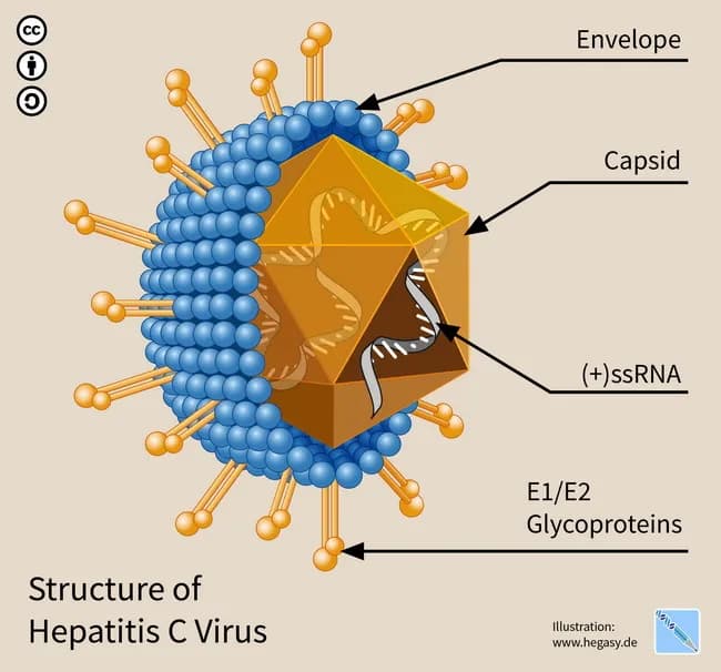 Imaging Modality: Educational digital illustration illustrating the structure of Hepatitis C virus (HCV). Technique: Digital vector rendering with color coding to distinguish the envelope, capsid, nucleic acid, and surface glycoproteins. This is not a clinical radiograph or microscopic image but a schematic cross‑section designed for teaching virology and infectious disease concepts. Location/Anatomical Context: depiction of a single enveloped virion, representing the extracellular particle rather than infected tissue; the virion comprises an outer envelope (lipid bilayer) containing E1/E2 glycoproteins surrounding the core capsid and the positive-sense single-stranded RNA genome. The RNA genome is depicted internally with associated nucleocapsid; annotations indicate (+)ssRNA, genome organization, and virion polarity. Pathological/Clinical Significance: emphasizes HCV biology relevant to pathogenesis and clinical disease, including its hepatotropism and reported associations with B-cell non-Hodgkin lymphomas such as extranodal marginal zone lymphoma (MALT lymphoma); antiviral therapy can clear infection and, in some cases, correlate with lymphoma regression. Diagnostic/educational relevance: supports molecular virology, vaccine design, antiviral targets (RNA polymerase, protease), and interpretation of host–virus interactions in hepatology and hematology. Use cases include medical education, conference materials, and research reviews on HCV structure–function relationships. (Credit: Guido4; CC BY-SA 4.0) Educational context includes virology exam prep, lecture slides, and online educational repositories for medical learners.