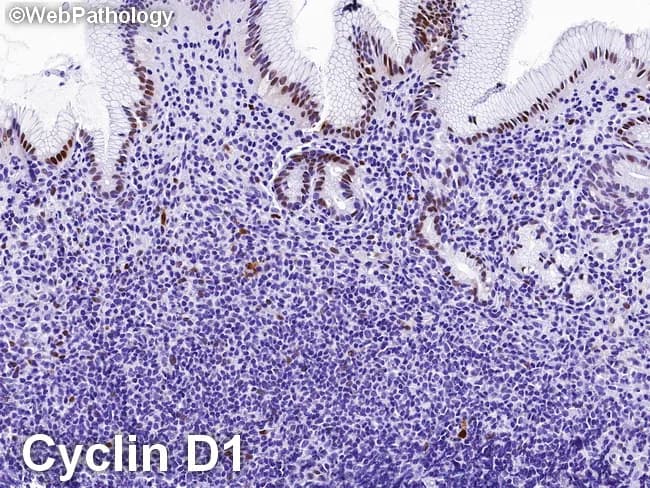 High-power gastric mucosal biopsy prepared for light microscopy with cyclin D1 immunohistochemistry demonstrates features characteristic of extranodal marginal zone B‑cell lymphoma of MALT type involving the stomach. In this specimen, a dense, monomorphic infiltrate of small to medium-sized lymphocytes expands the lamina propria and surrounds gastric glands, forming classic lymphoepithelial lesions. The neoplastic cells typically exhibit irregular, slightly indented nuclei with scant cytoplasm and inconspicuous nucleoli; plasmacytoid differentiation may be present in focal areas. Immunohistochemical staining is negative for cyclin D1, supporting a MALT phenotype and helping distinguish from mantle cell lymphoma, which is cyclin D1 positive. The neoplastic cells reliably express B‑cell markers (CD20/CD79a) and often show light-chain restriction, consistent with a monoclonal B‑cell population arising in mucosa‑associated lymphoid tissue. Background reactive lymphoid infiltrates and H. pylori–associated gastritis can accompany the neoplasm. Clinically, MALT lymphoma of the stomach is frequently associated with Helicobacter pylori infection and is potentially amenable to antibiotic eradication therapy, with response rates correlating with stage and H. pylori status. Radiologic and endoscopic correlation may reveal regional gastric wall involvement but histology remains essential for diagnosis, grading, and staging. This image underlines the diagnostic utility of cyclin D1 negativity in differentiating gastric MALT lymphoma from cyclin D1‑positive mantle cell lymphoma.