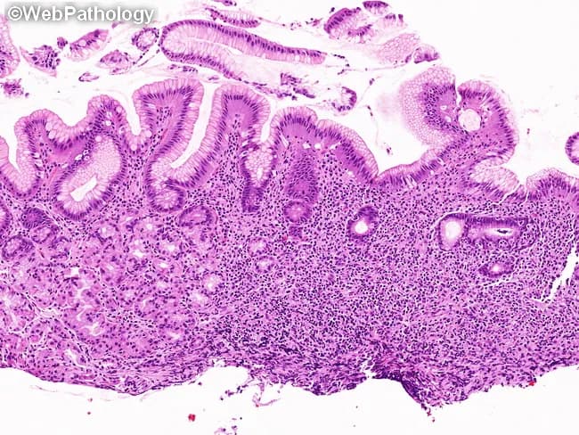 Imaging modality and technique: This image is a histopathology micrograph obtained from a gastric mucosal biopsy and viewed under light microscopy after formalin fixation and Hematoxylin and Eosin (H&E) staining. The specimen shows gastric mucosa with intact surface epithelium and deep lamina propria infiltrated by a dense, monomorphic lymphoid population that distorts and displaces the native gastric glands. The infiltrate is composed of small to medium-sized lymphocytes with relatively uniform nuclear contours and scant cytoplasm, characteristic of marginal zone B-cells seen in MALT lymphoma. Lymphoepithelial lesions are present as lymphoid cells invade and disrupt gastric glands, a hallmark of extranodal marginal zone lymphoma of MALT. There is minimal overt cytologic atypia and preserved overall tissue architecture aside from glandular distortion, a pattern that supports an early or low-grade MALT process rather than high-grade transformation. The image highlights a localized gastric mucosal process; in the clinical setting, such histology often correlates with Helicobacter pylori infection and response to antibiotic eradication therapy in localized disease. Differential considerations include gastritis with reactive lymphoid aggregates, other gastric B-cell lymphomas, and gastric adenocarcinoma with reactive lymphoid infiltrates. Overall, the finding confirms gastric MALT lymphoma pathology and informs staging, surveillance, and therapeutic planning.