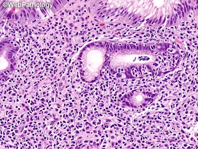 This histopathology image depicts a high-magnification hematoxylin and eosin stained section of gastric mucosa, illustrating a lymphoepithelial lesion characteristic of gastric mucosa-associated lymphoid tissue (MALT) lymphoma. Dense infiltration by small to intermediate-sized lymphocytes disrupts normal gastric glands, with marked invasion of glandular epithelium and glandular destruction. A modest plasmacytic component is present within the infiltrate, giving rise to plasmacytoid cells and occasional plasma cells adjacent to lymphoid aggregates. The surrounding lamina propria is expanded with lymphoid tissue, including rare intracellular plasma cells. MALT lymphoma etiologies include Helicobacter pylori infection; tumor cells are typically marginal zone B-cells that may form lymphoepithelial lesions within gastric glands. In this image, glands are variably spared, but architectural effacement and epithelial damage reflect neoplastic lymphoid infiltration rather than simple chronic gastritis. The cytology shows cohesive lymphoid sheets with relatively uniform nuclei, inconspicuous nucleoli, and scant mitotic activity in well-differentiated areas; occasional reactive lymphoid follicles may be seen elsewhere. Overall, the image exemplifies characteristic histopathologic features used to diagnose gastric MALT lymphoma and to distinguish it from chronic gastritis and other gastric lymphomas; the finding supports targeted clinical management decisions. Correlate with H. pylori status and molecular tests for complete diagnostic characterization and therapeutic planning guidance.