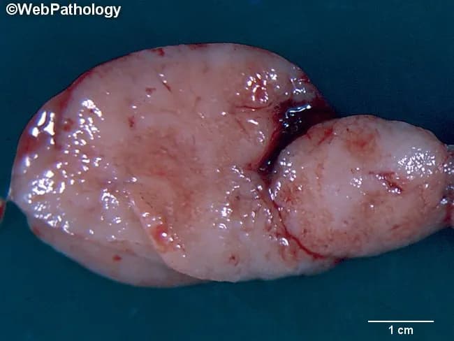 Gross pathology photograph of a surgically excised lymph node demonstrating a pale, glistening, lobulated soft tissue mass approximately 2–3 cm in maximal dimension, fixed in formalin. The specimen exhibits smooth external surface with minor irregularities; no obvious necrosis or hemorrhage on the visible outer contour; the cut surface (if provided) would be expected to reveal tan-white homogeneous to mottled nodal tissue. Context: Hodgkin lymphoma diagnosis typically requires histologic confirmation of Hodgkin and Reed–Sternberg (HRS) cells within a fibrous stroma; cytogenetics and comparative genomic hybridization may reveal chromosomal gains in 2p, 9p, 11q, and losses in 4q and 11q, with amplification of REL (2p16) and 9p24 (JAK2, PD-L1/PD-L2), contributing to NF-κB and JAK/STAT signaling. From a gross image alone, the diagnosis cannot be confirmed; this image is best used for educational demonstration of nodal gross morphology and biopsy guidance. Clinically relevant to staging workup, differential diagnosis includes reactive nodes, other lymphomas, and metastatic cancers. This specimen supports pathologist correlation with microscopic histology, immunophenotyping (CD15, CD30), EBV status, and cytogenetic results to establish classic Hodgkin lymphoma. Potential educational uses include gross pathology atlases, tumor biology teaching, and multidisciplinary case discussions. These cues guide biopsy sampling and correlate with prognosis.
