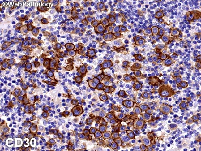 Brightfield immunohistochemistry on formalin-fixed paraffin-embedded lymph node tissue demonstrates classical Hodgkin lymphoma immunophenotype with CD30-positive Reed-Sternberg (RS) cells embedded in a dense reactive inflammatory milieu. The RS cells are rare (roughly 0.1–0.2% of cells) and display characteristic large, often multilobed nuclei with prominent nucleoli, set in a rich background of lymphocytes, eosinophils, plasma cells, and histiocytes. Immunostaining is strong and membranous with a dot-like Golgi pattern in the perinuclear zone, consistent with CD30 expression. Additional activation-associated markers may include CD25, CD40, CD71, and HLA-DR, while CD45 is typically negative, with variable expression of other lineage-associated antigens. The slide highlights the diagnostic dichotomy between RS cells and the surrounding reactive cells; in nodular lymphocyte-predominant HL, LP cells are CD30 negative but may show weak staining. The CD30 positivity supported by the current image confirms classic HL and helps distinguish from CD30-positive non-Hodgkin lymphomas such as anaplastic large cell lymphoma or certain peripheral T-cell lymphomas. This immunophenotype has therapeutic relevance, guiding consideration of CD30-targeted therapies and prognostic stratification, and is diagnostic of classic Hodgkin lymphoma in the appropriate clinical and histopathologic context. Correlation with nodal architecture, lacunar RS variants, and prominent inflammatory microenvironment; influences staging, prognosis, and eligibility for CD30-directed therapies such as brentuximab vedotin in relapsed or refractory classic Hodgkin lymphoma.