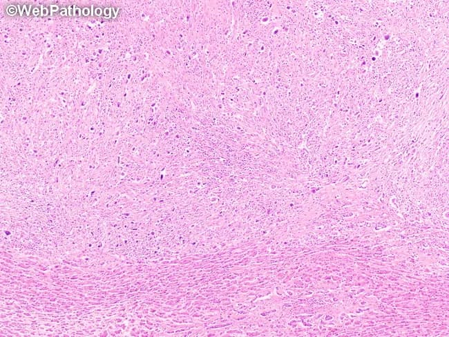 Histopathology illustration of liver tissue demonstrating lymphocyte-depleted classic Hodgkin lymphoma (cHL) with hepatic involvement. The section shows a diffuse fibrotic reticulin network (heavy background fibrosis) with hypocellular cellularity and sparse non-neoplastic inflammatory cells, in contrast to prominent Reed-Sternberg (RS) cells. RS cells are large, often binucleate with prominent nucleoli, and may exhibit sarcomatoid or bizarre mononucleate morphology; in this pattern they are the key diagnostic clue amidst scant lymphocytes. The image captures EBV-associated RS cells as typical features of lymphocyte-depleted cHL, seen in about 90% of such cases. The bottom of the field reveals normal liver parenchyma for comparison, underscoring focal hepatic involvement within otherwise normal hepatic architecture. Clinically, lymphocyte-depleted cHL frequently presents with advanced disease, fever, hepatomegaly, pancytopenia or lymphopenia, and bone marrow involvement; nodal adenopathy may be minimal or absent. Immunophenotypic confirmation (CD30+, CD15+, PAX5 weak) and EBV in situ hybridization (EBER) are commonly employed to support diagnosis. This image is valuable for education and diagnostic training, illustrating the aggressive, low-cellularity variant, the importance of recognizing RS cells in a fibrotic milieu, and the prognostic implications of liver involvement and EBV positivity in Hodgkin lymphoma. These features are essential for differential diagnosis, prognosis, and guiding systemic therapy in advanced Hodgkin lymphoma.
