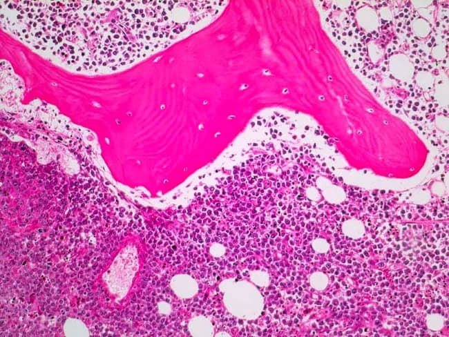 This histopathology image depicts a bone marrow biopsy section stained with Hematoxylin and Eosin (H&E) at light microscopy. The normal marrow architecture is variably disrupted with focal to diffuse infiltration by large neoplastic lymphoid cells. The malignant cells display abundant cytoplasm, conspicuous nuclei with vesicular chromatin, and prominent nucleoli, forming sheets that partially replace hematopoietic tissue and normal adipose elements. A delicate pink stromal background and scattered macrophages are evident; residual marrow elements show diminished erythroid and myeloid precursors in zones of tumor involvement. The pink fibrillary areas likely reflect fibrous marrow or reactive reticulin fibers. In this frame, the cellular density is high and mitotic activity appears brisk, consistent with an aggressive B-cell lymphoma morphology. Immunophenotypically, the tumor cells are CD20 positive (as noted clinically), supporting a diagnosis of diffuse large B-cell lymphoma (DLBCL) involving the bone marrow. The image exemplifies marrow involvement by a systemic lymphoma and illustrates two clinicopathologic scenarios discussed in DLBCL: concordant marrow involvement (same lymphoma histology in nodal and marrow sites) versus discordant involvement (indolent lymphoma in marrow with high-grade disease elsewhere). This case emphasizes the prognostic and staging implications of marrow infiltration and the potential impact on treatment planning, including rituximab-containing regimens options.