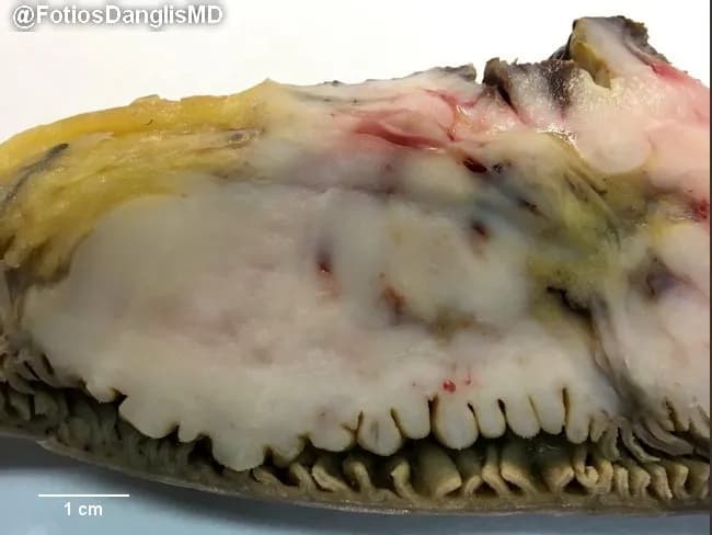 Macroscopic photograph of a surgically resected small bowel segment illustrating transmural infiltration by diffuse large B‑cell lymphoma. The intestinal wall is diffusely thickened; mucosal folds are effaced and markedly expanded by tumoral tissue, producing a plaque‑like, bulky appearance along the luminal surface. The serosa shows no distinct gross ulceration in this view, though focal friability and areas of pale yellow to tan coloration reflect tumor replacement of normal wall layers. The tumor mass extends through the mucosa and submucosa with involvement of the deeper wall, consistent with lymphomatous infiltration. The surrounding mesenteric fat appears unremarkable in this slice, and vascular demand is not assessable in this plane. A centimeter scale bar is provided for size reference, indicating that the thickening spans several centimeters in length and a few millimeters in wall thickness. This gross pattern, combined with the clinical diagnosis of small bowel diffuse large B‑cell lymphoma (DLBCL), correlates with aggressive non-Hodgkin lymphoma of the gastrointestinal tract. Clinically, DLBCL of the small intestine presents with obstructive symptoms, abdominal pain, and weight loss; management typically combines surgical resection with systemic chemotherapy (e.g., R‑CHOP). This image is valuable for education on gross morphology of lymphomatous involvement, differential with other small bowel neoplasms, and radiologic correlation.